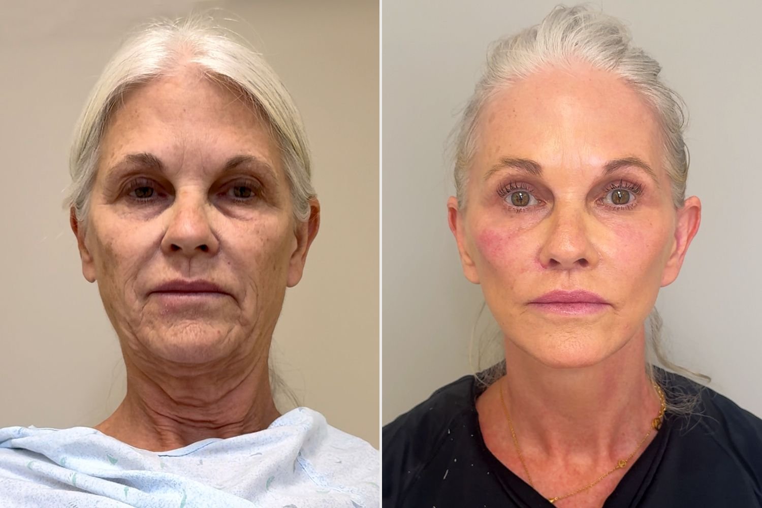 Double Jaw Surgery Recovery Timeline: Week-by-Week Healing Guide